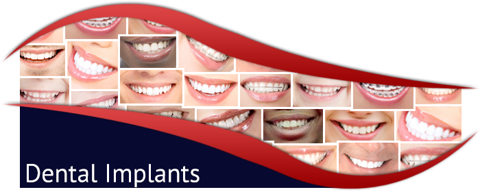 Dental Implants Header Photo